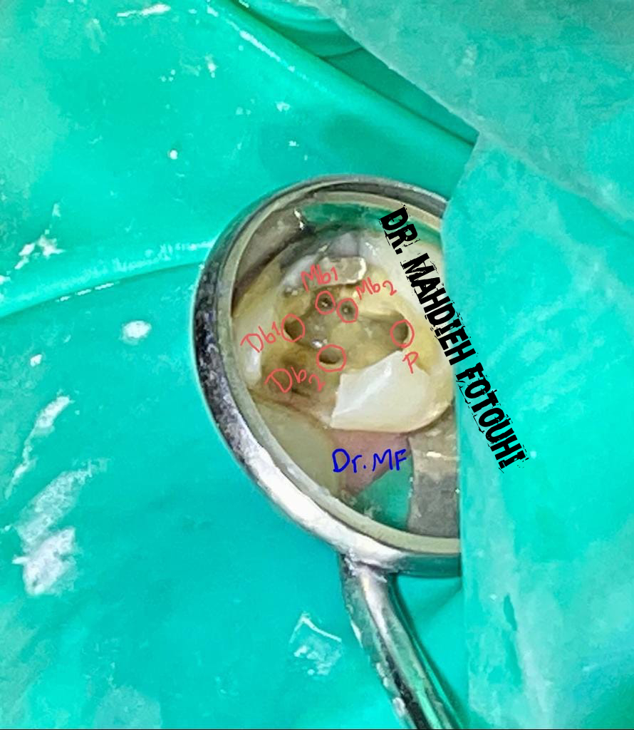 Root Canal Treatment Of upper first Molar tooth with 5 Canals